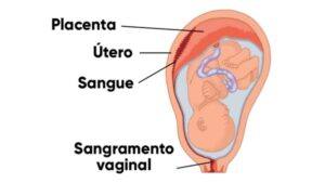 Descolamento da placenta com feto vivo
