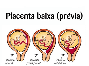 Ilustrações de Placenta Prévia